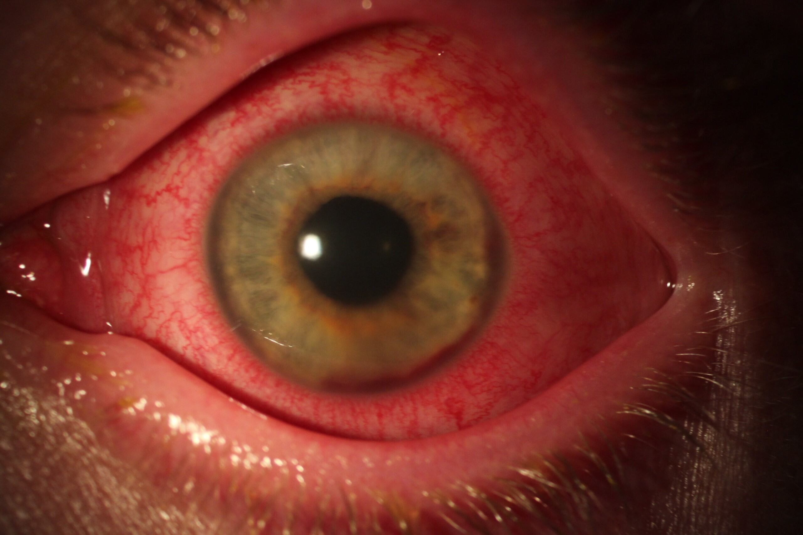 Iritis & Anterior Uveitis Innovative Eye Care